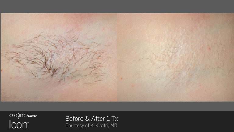 Icon™ - Before and After Photo - Hair Removal
