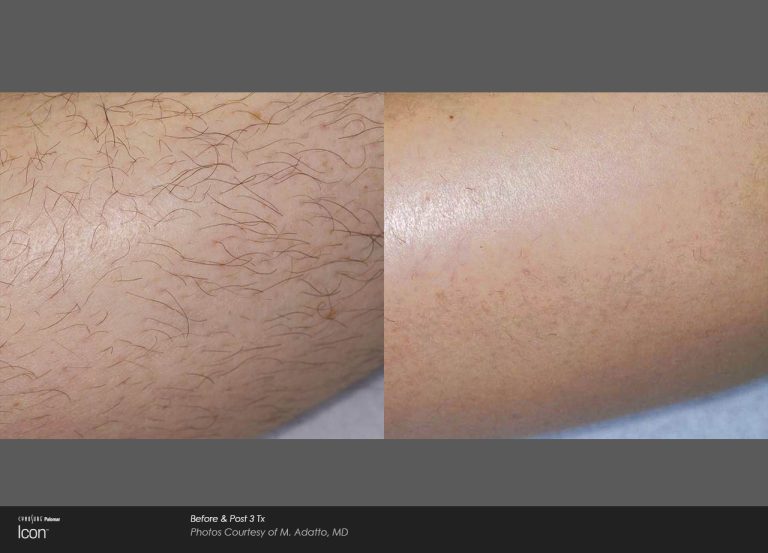Icon™ - Before and After Photo - Hair Removal