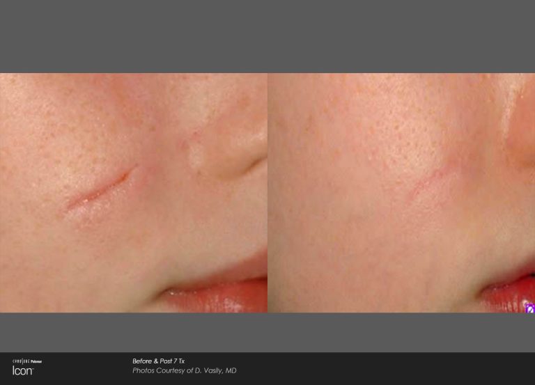 Icon™ - Before and After Photo - Scar Removal
