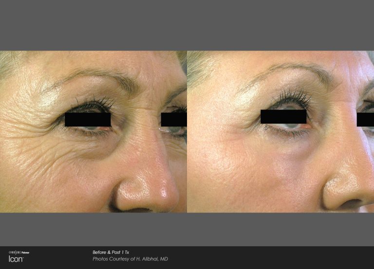 Icon™ - Before and After Photo - Skin Resurfacing