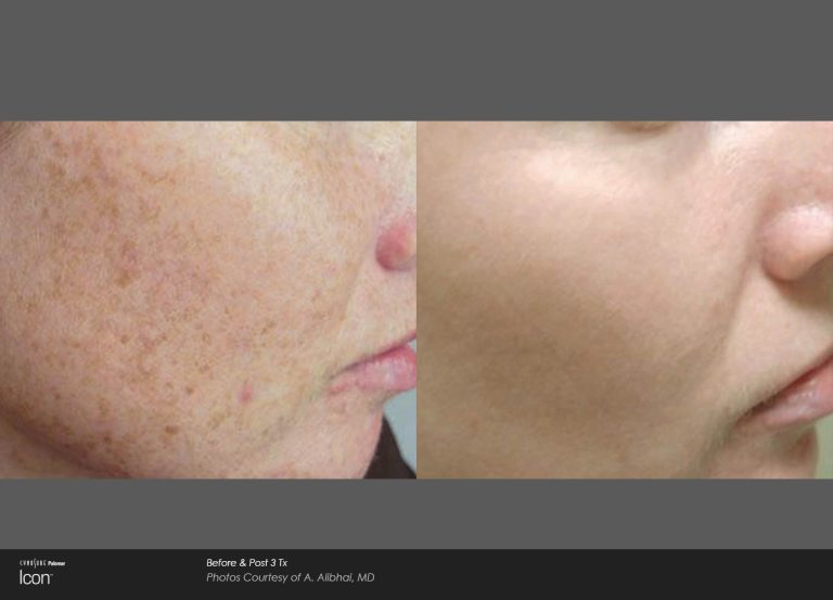 Icon™ - Before and After Photo - Skin Revitalization