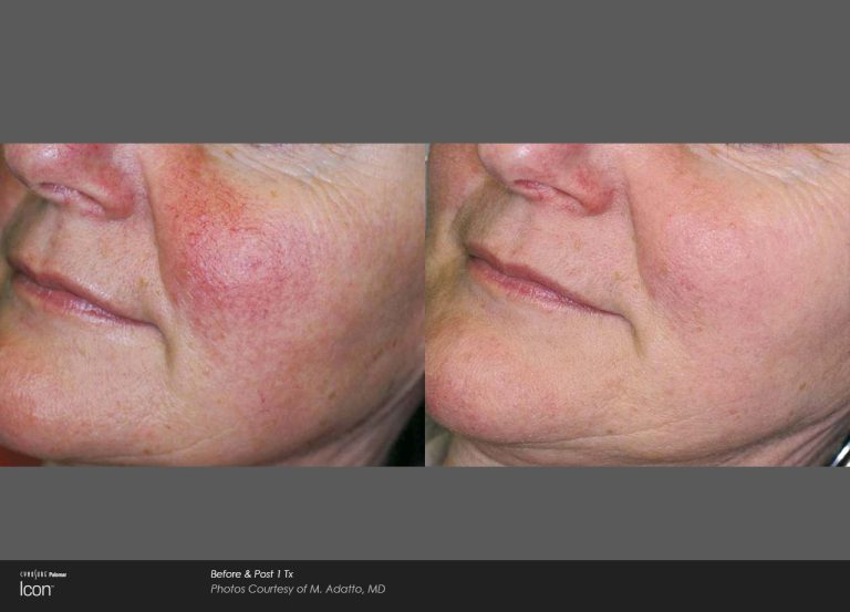 Icon™ - Before and After Photo - Skin Revitalization