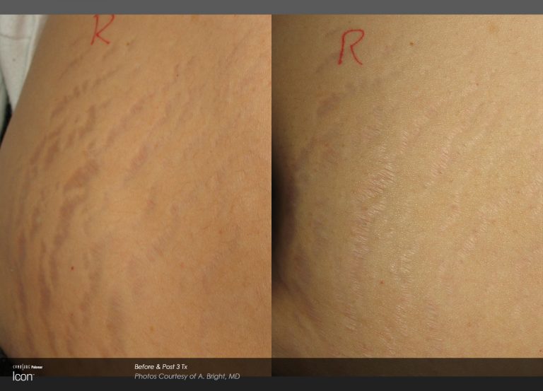 Icon™ - Before and After Photo - Stretch Mark